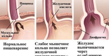 Гастроэзофагеальная рефлюксная болезнь (ГЭРБ)