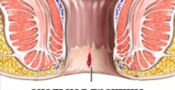 Анальная трещина (царапина)