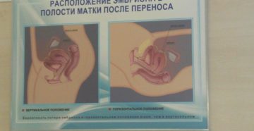 Тонус матки после переноса эмбрионов