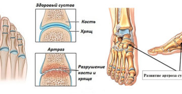 Хрящи стопы