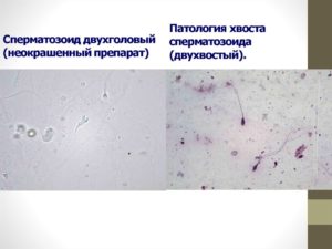 Спермограмма. патология хвоста.