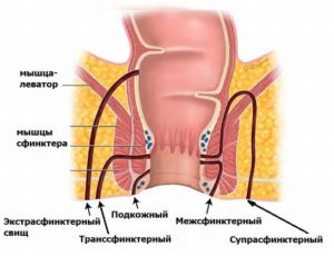 чрессфинктерный свищ