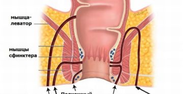 чрессфинктерный свищ