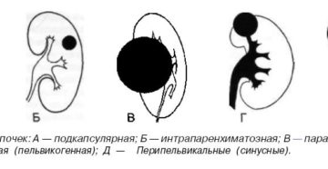 Перипельвикальная киста почки