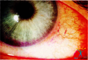 Роговично-конъюнктивальный ксероз (синдром «сухого» глаза)