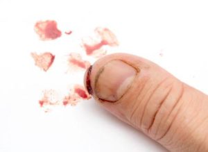 Cкальпированная рана пальца (подушечка мезинца)