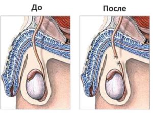 возможна ли пересадка яичка взрослому мужчине от его отца?