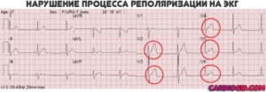 Симптомы болезни - нарушенияпроцессов реполяризации желудочков