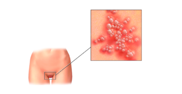 Генитальный герпес: Справляясь с диагнозом