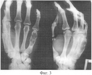 Энхондрома пятой пястной кости левой кисти