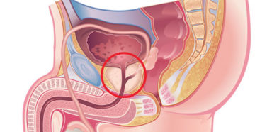 Простата будто тянет