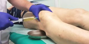 Нъекции креспин-гель плюс в коленный сустав