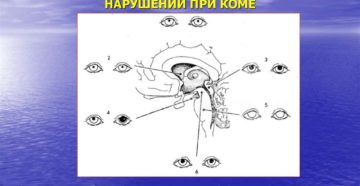 Зрачковые нарушения при парасимпатической патологии