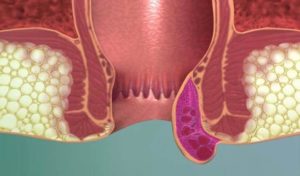 Анальная трещина при беременности