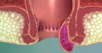 Анальная трещина при беременности