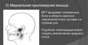 Симптомы болезни - миофасциальные боли