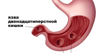 Язвенная болезнь желудка и двенадцатиперстной кишки