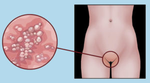 Лечение генитального герпеса в домашних условиях