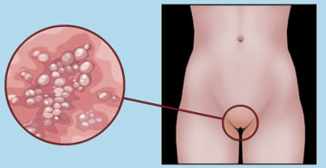 Лечение генитального герпеса в домашних условиях