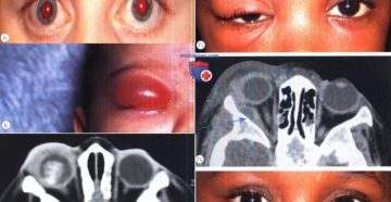 Воспалительные заболевания глазницы