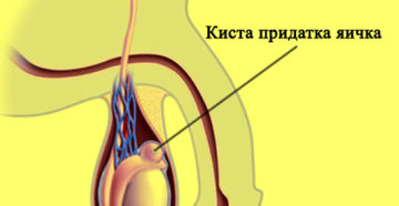 Бугорок на правом яичке сверху