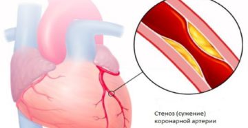 Стенокардия