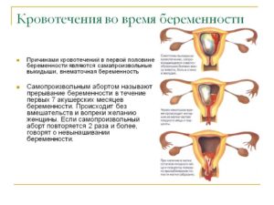 Кровотечения во время беременности