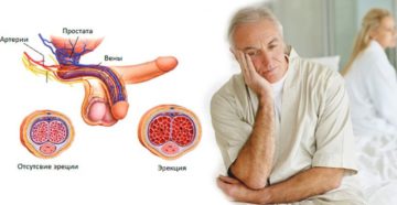 Симптомы болезни - нарушения эрекции