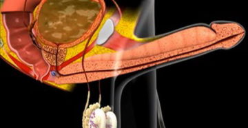 Не встает половой член без стимуляции