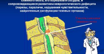 Повреждения позвоночника, осложненные травмой спинного мозга