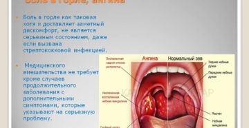 Боль в горле после сна