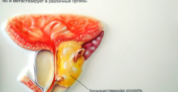 Как мне узнать, есть ли у меня рак предстательной железы?