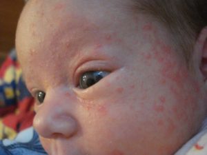 Как избавиться от аллергии невыясненного происхождения у 3х месячного ребенка