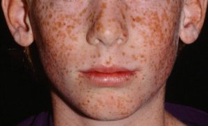 Симптомы болезни - нарушения пигментации кожи