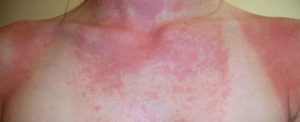 Виды аллергии, которые проявляются летом