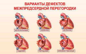 Вроджений дефект міжпередсердної перегородки.