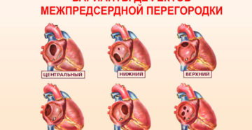 Вроджений дефект міжпередсердної перегородки.