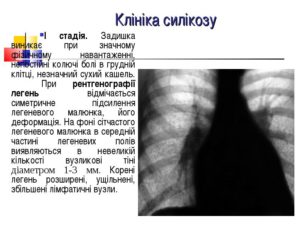 Легеневий малюнок збагачений