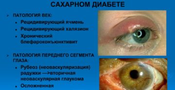Проблемы с глазами при сахарном диабете