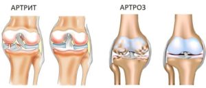 Артрит и артроз: есть ли разница?