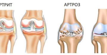 Артрит и артроз: есть ли разница?