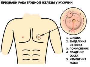 Уплотнение в области соска у мальчика