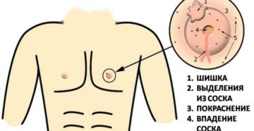 Уплотнение в области соска у мальчика