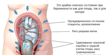 Гипертонус матки при беременности