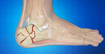 раздробление пяточной кости
