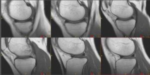 Расшифруйте МРТ , травма колена