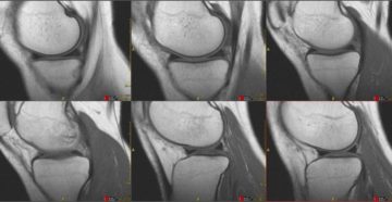Расшифруйте МРТ , травма колена