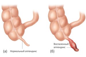 Острый аппендицит