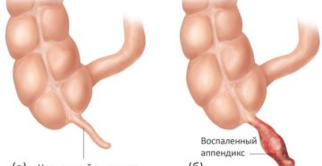 Острый аппендицит