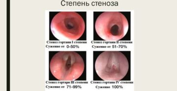 Острый стеноз гортани и трахеи